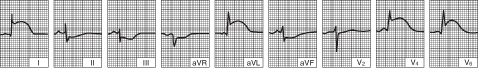 Acute Lateral Left ventricular Infarction (tracing obtained within a few hours of onset of illness)