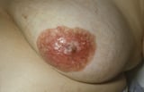 Paget Disease of the Breast