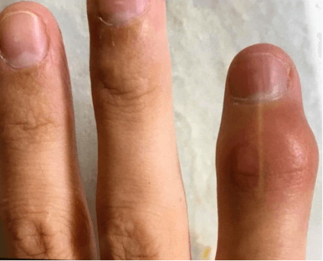 Schwellung eines Fingerendgelenks (distales Interphalangealgelenk)