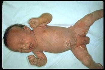 Стафилококковый ожогоподобный кожный синдром (у новорожденного)