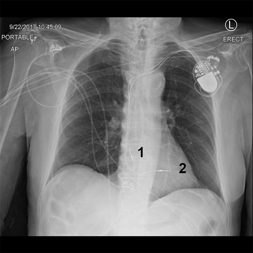 Рентгеновский снимок грудной клетки пациента с кардиостимулятором
