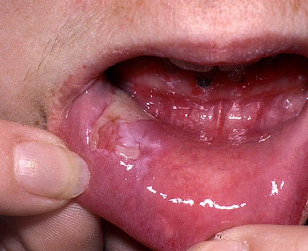 Pemphigus thông thường (miệng)