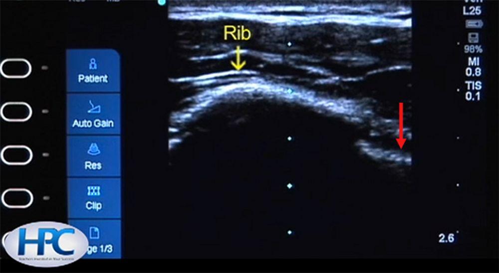 Ultraschallbild der Rippen und der Pleuralinie