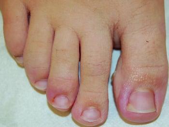Врастание ногтя пальца стопы