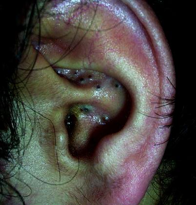 Punti neri in un orecchio