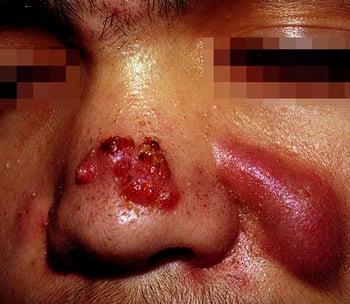 Ascesso causato dall’acne