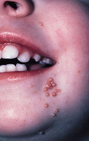 Molusco contagioso no rosto de uma criança