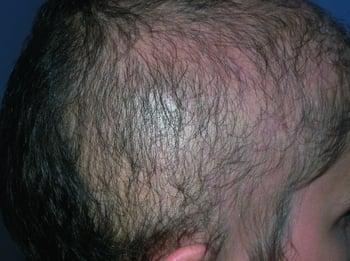 Hair-Pulling Disorder (Trichotillomania)