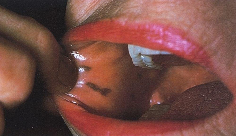 Синевато-черные пятна во рту (Синдром Пейтца-Егерса)
