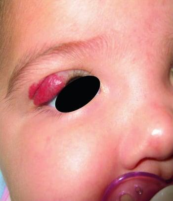 Capillary Hemangioma in the Eyelid