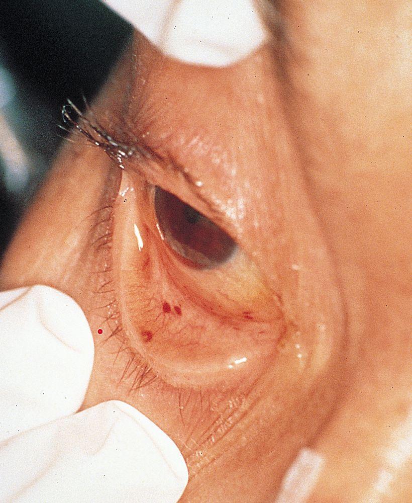 Endocarditis infecciosa (ojo)