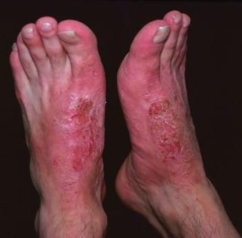 Dermatite de contato (pés)