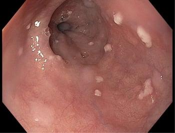 Infezione dell’esofago causata da Candida