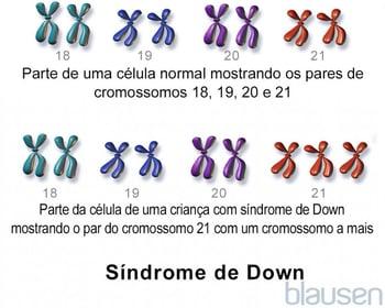 Síndrome de Down: Trissomia 21