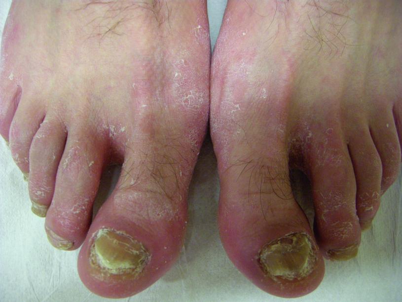 足背の鱗屑を伴う足白癬