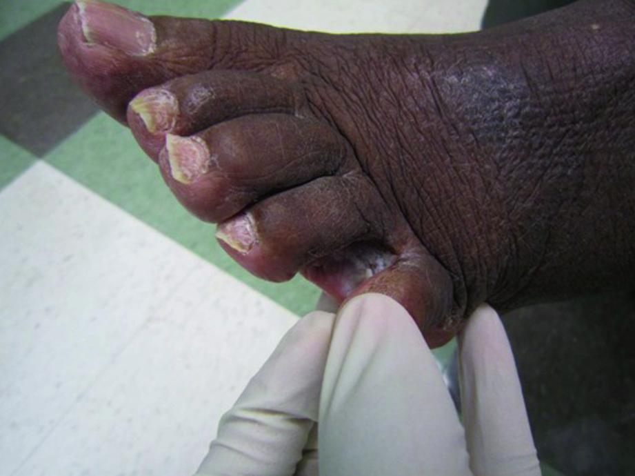 皮膚の色の濃い患者の足白癬