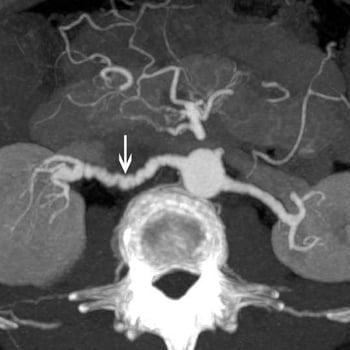 Displasia fibromuscolare dell'arteria renale