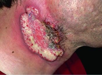 Síndrome PAPA (artrite piogênica, pioderma gangrenoso e síndrome de acne)