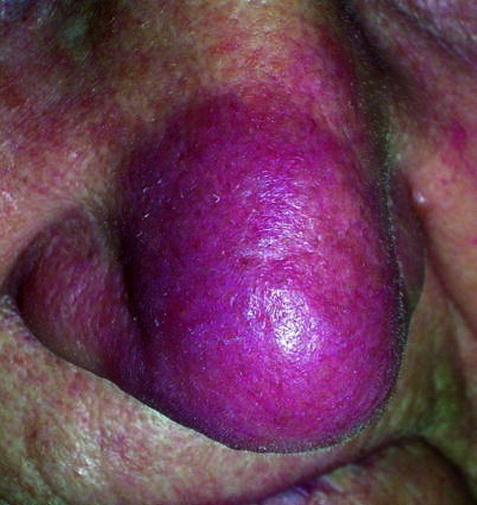 Sarcoidosi (lupus pernio)