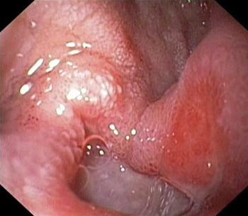 Ulcera duodenale