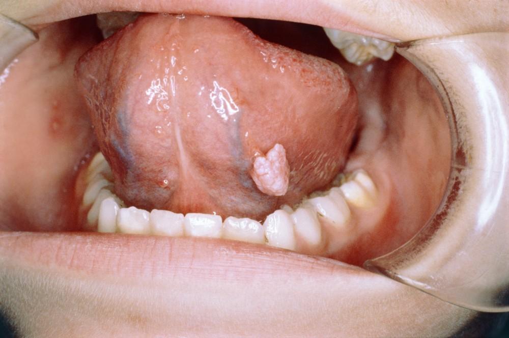Squamous Papilloma of the Tongue