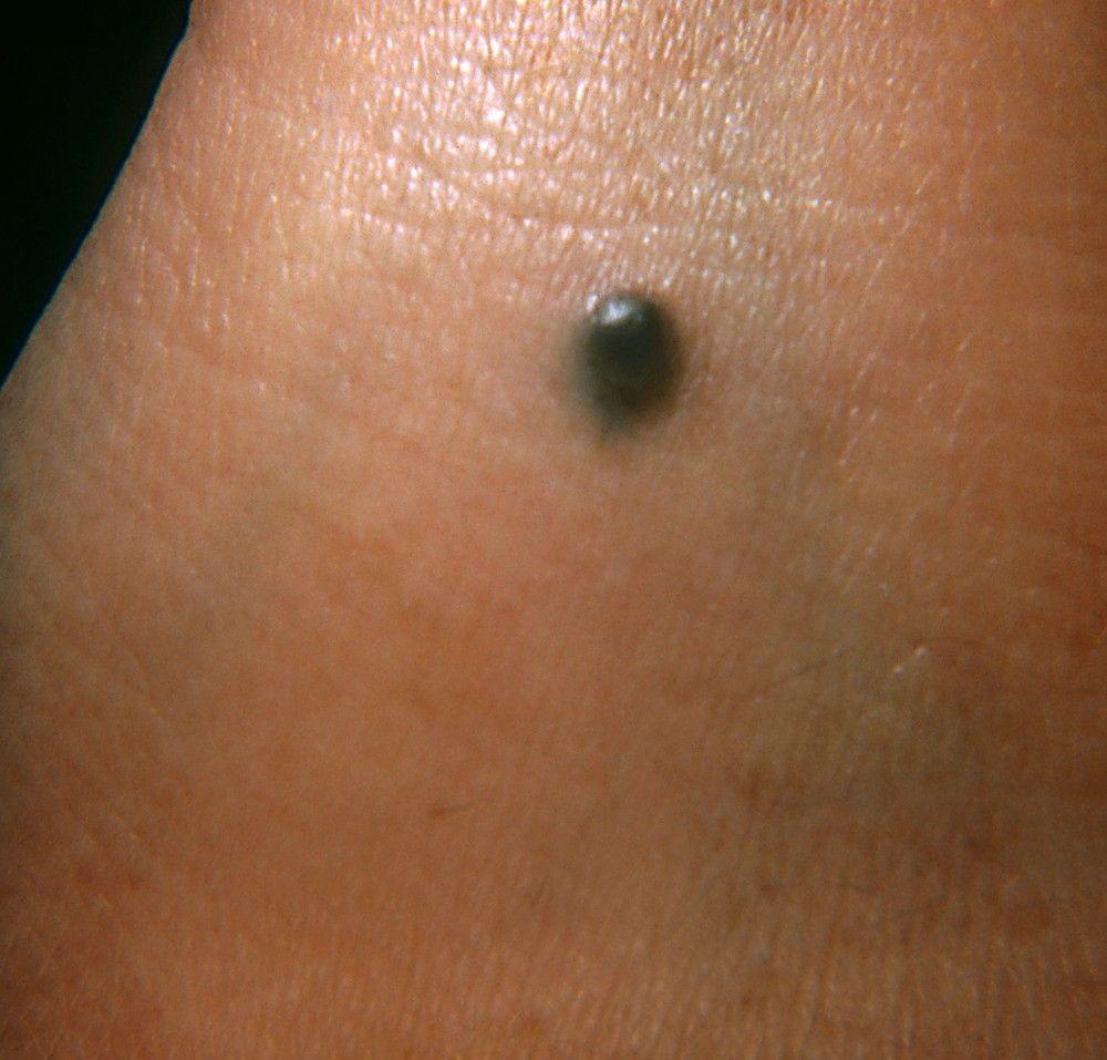 Blue Nevus