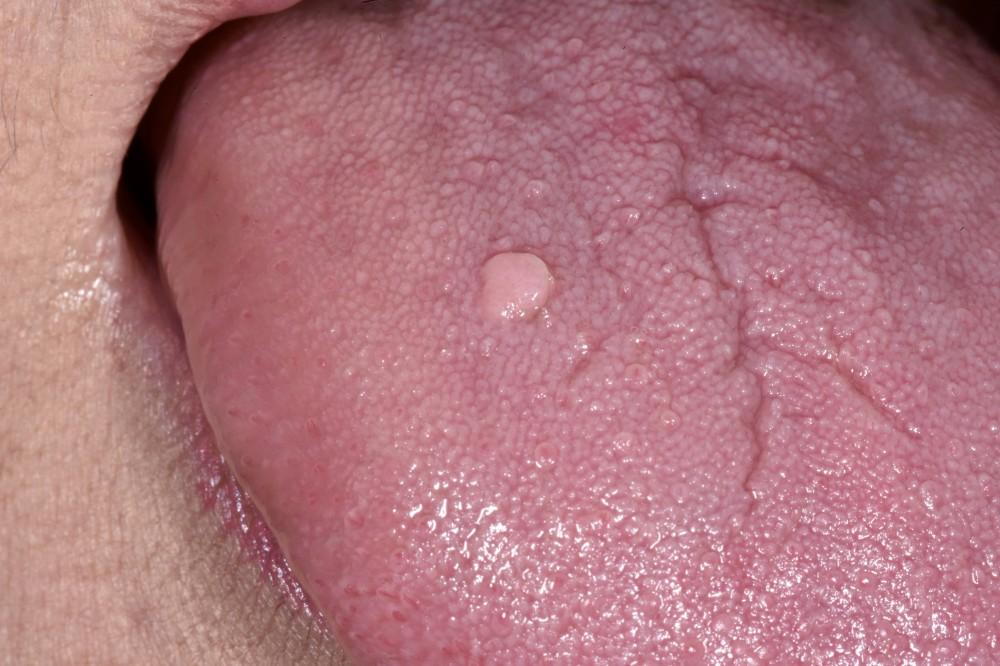 Squamous Papilloma – Ordinary Wart