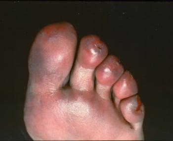 足趾の凍瘡（しもやけ）