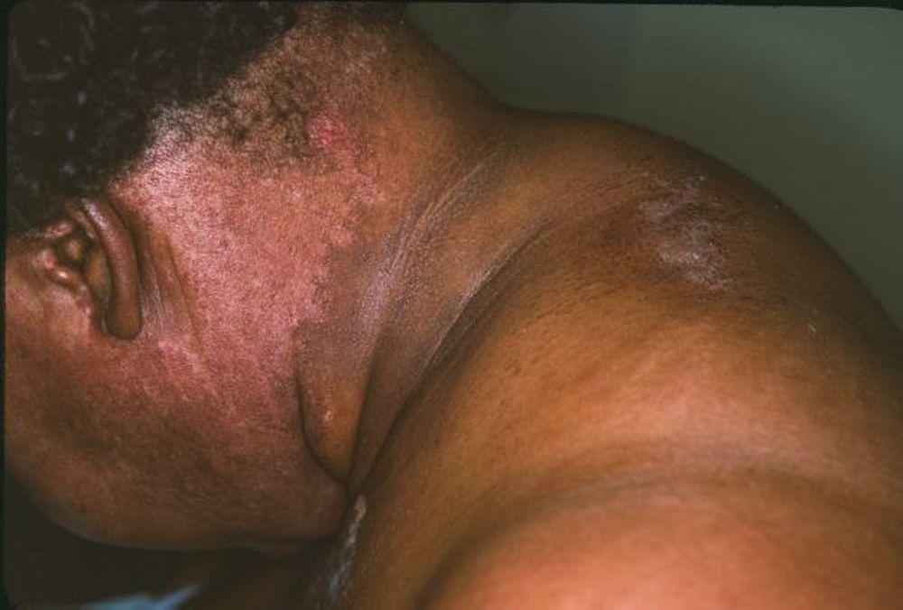 Dermatomyositis (Hals)