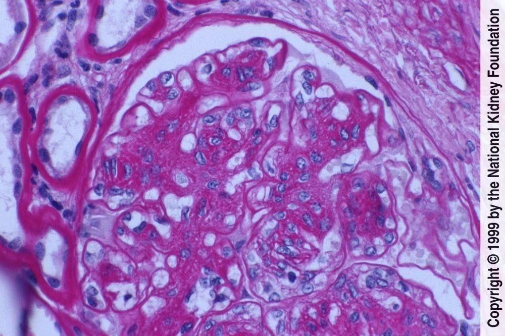 Diabetic Nephropathy (Mesangial Cell Proliferation and Matrix Expansion)