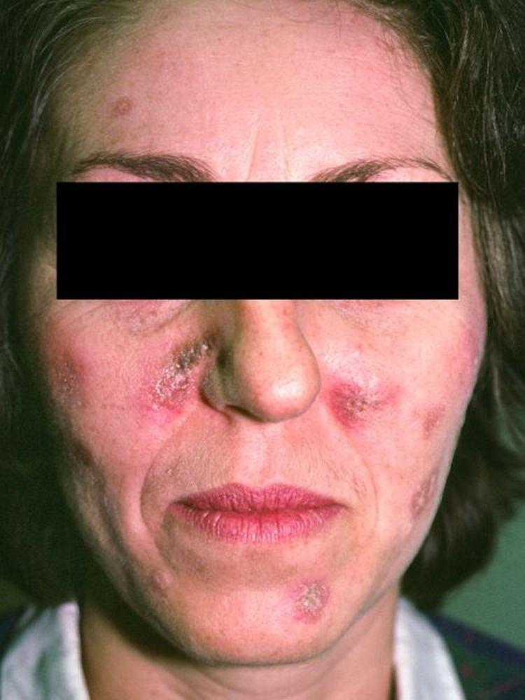 Diskoider Lupus erythematodes des Gesichts (1)