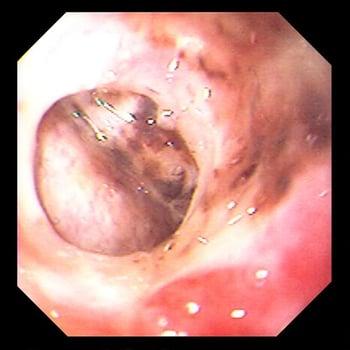 Perfuração por úlcera gástrica