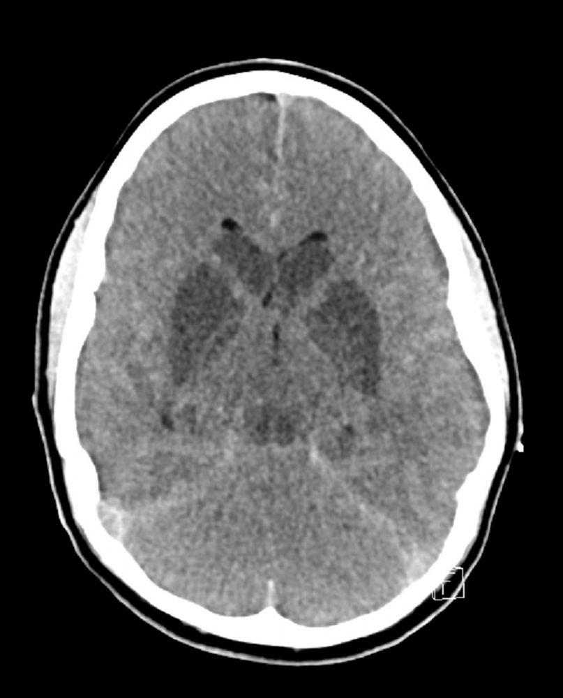 Lesão cerebral isquêmica hipóxica e edema cerebral