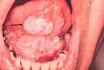 Leukoplakia and Squamous Cell Carcinoma