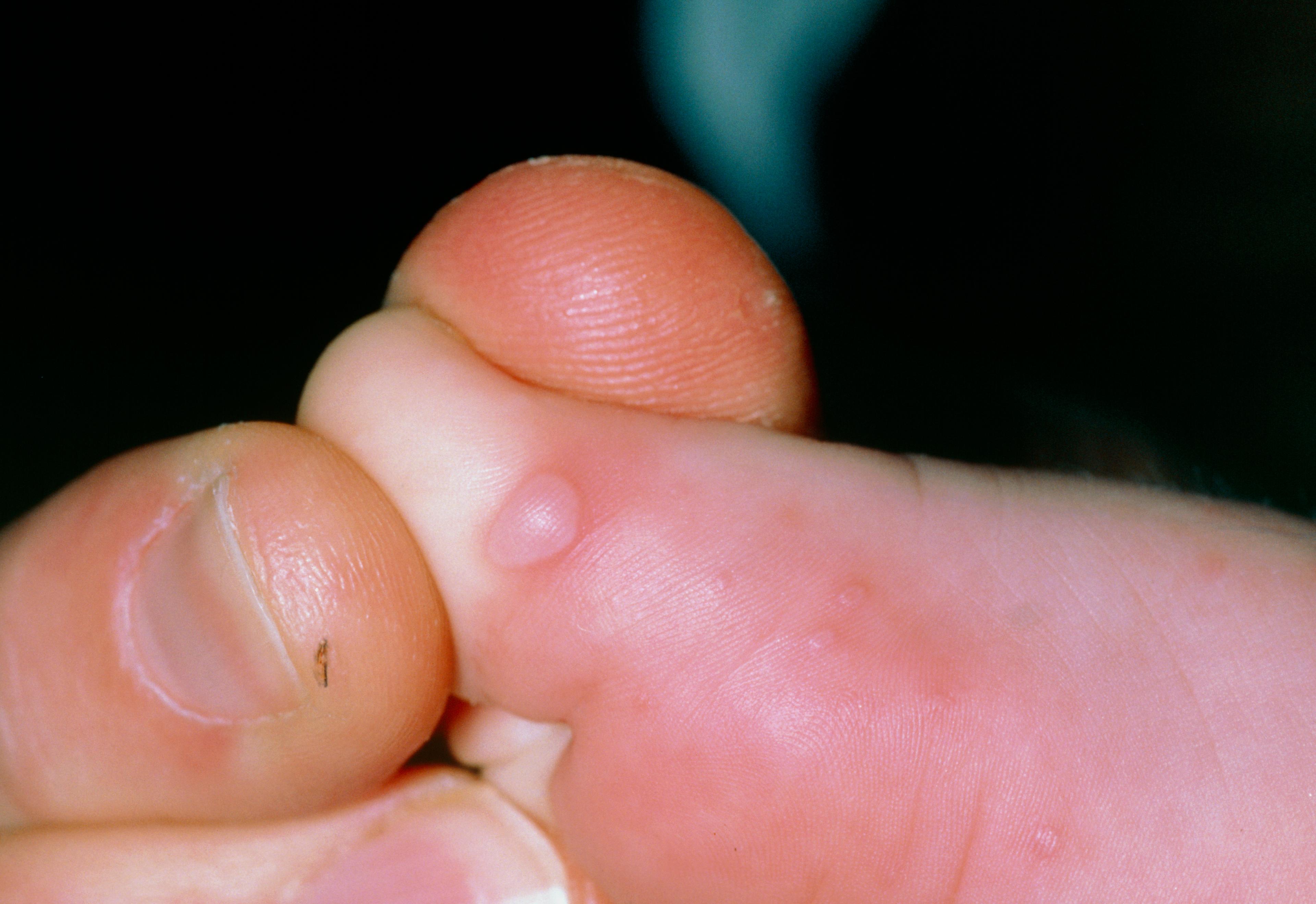 コクサッキーウイルスA群による発疹（足の病変）
