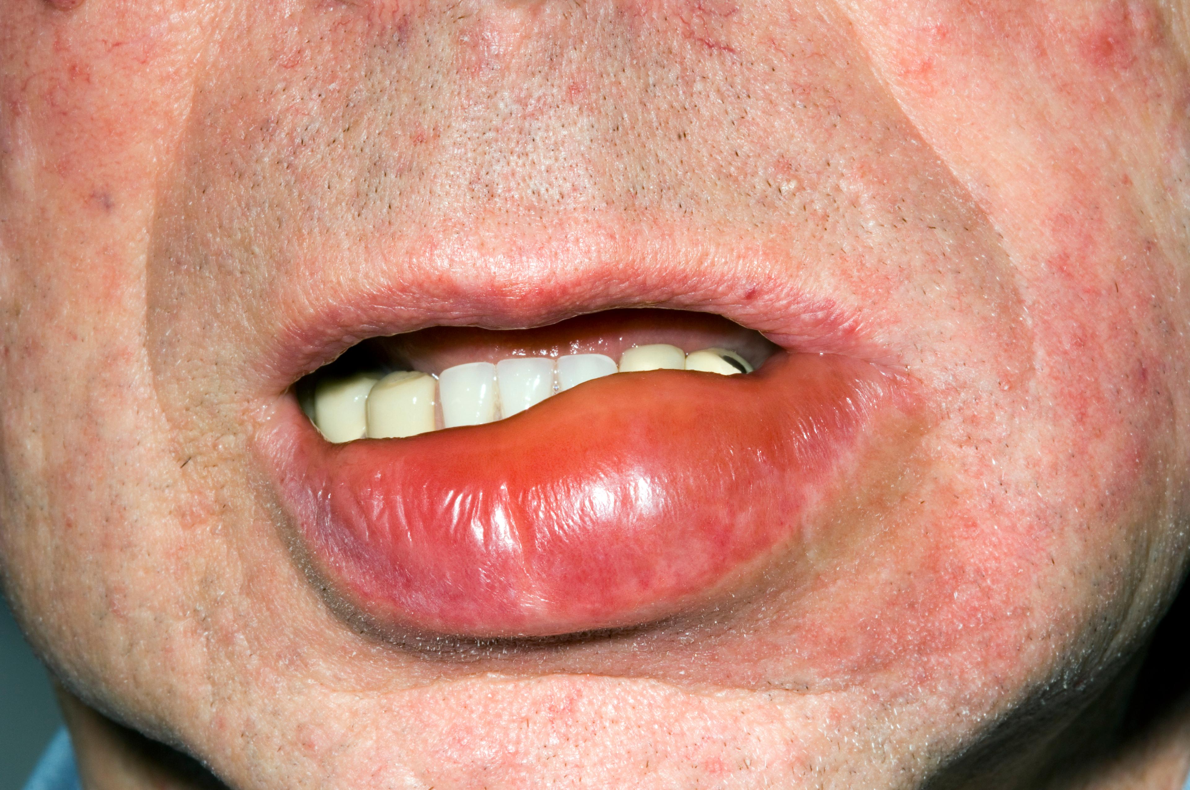 口唇の血管性浮腫