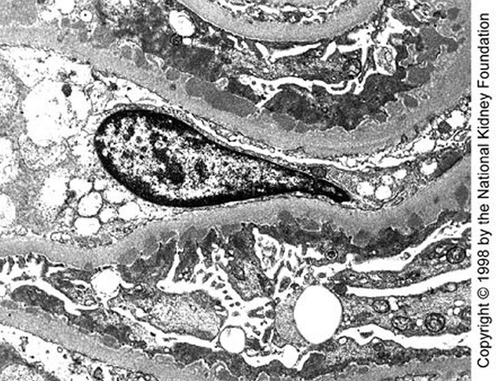Nefropatia membranosa (depositi densi)