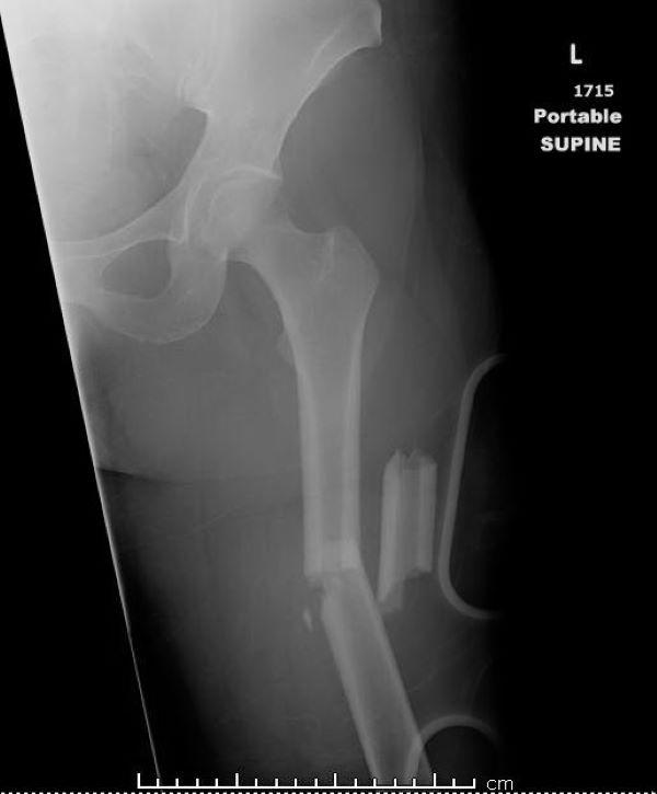 大腿骨骨幹部骨折（1）
