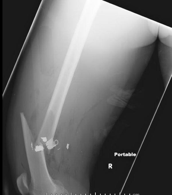 大腿骨骨幹部骨折（2）