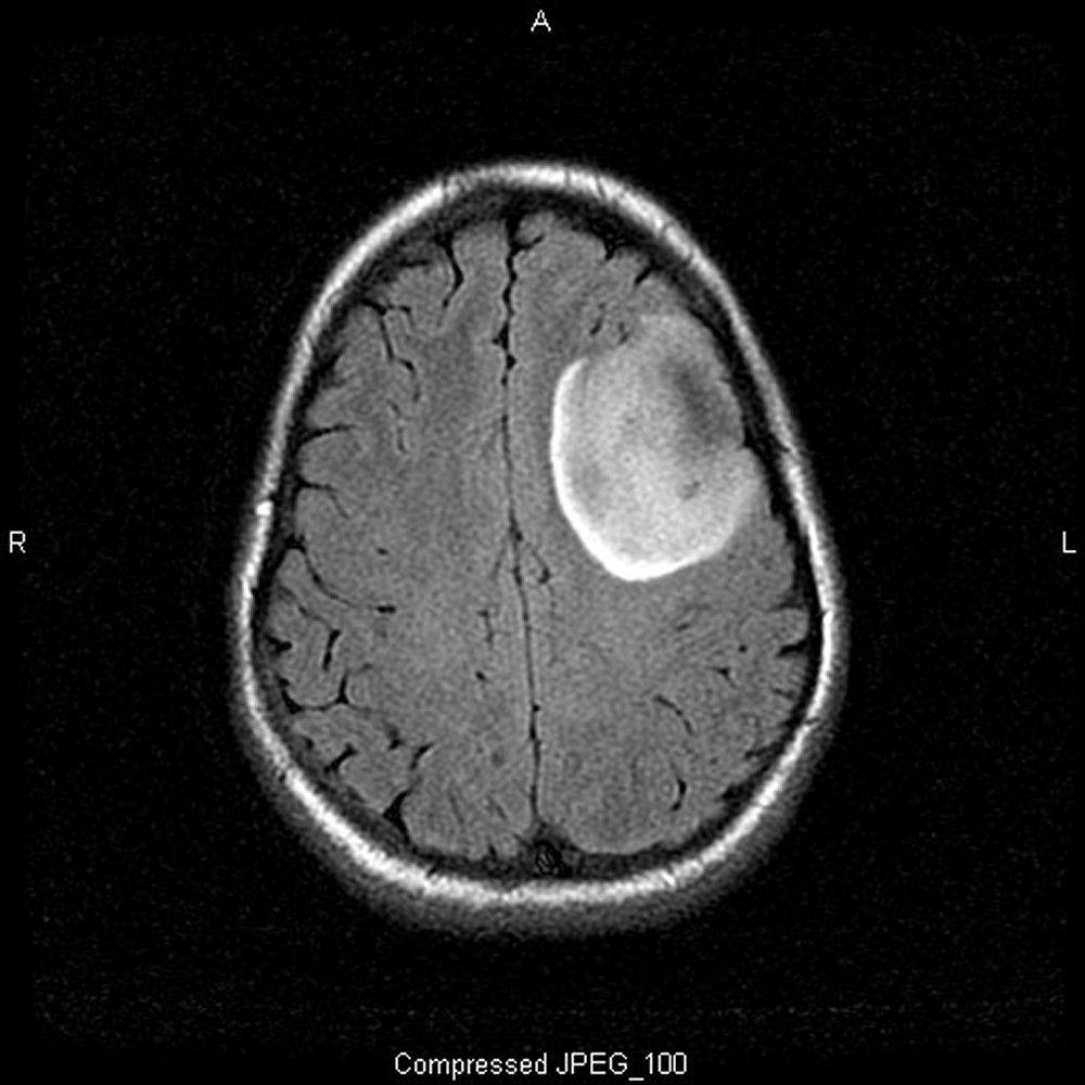 Oligodendroglioma, Low-Grade