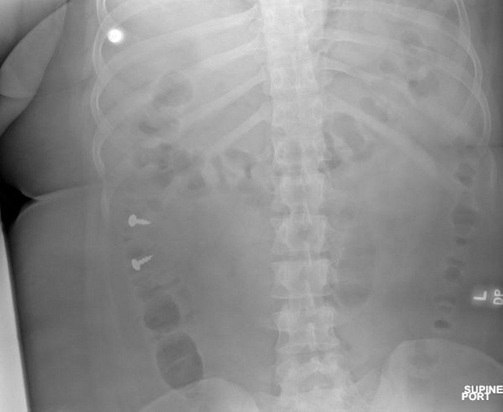 Screws in Colon (X-Ray)