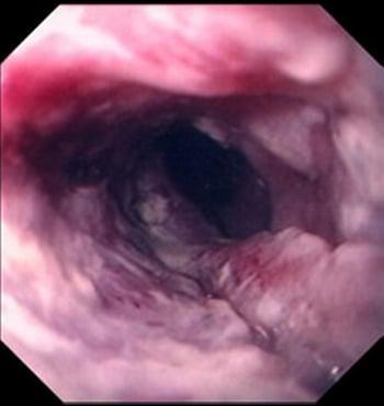 Carcinoma squamocellulare dell'esofago