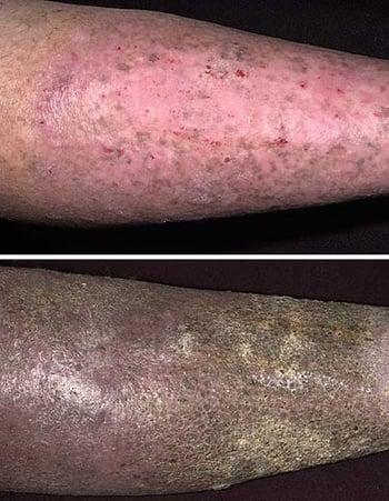 Dermatite da stasi (cambiamenti cronici)