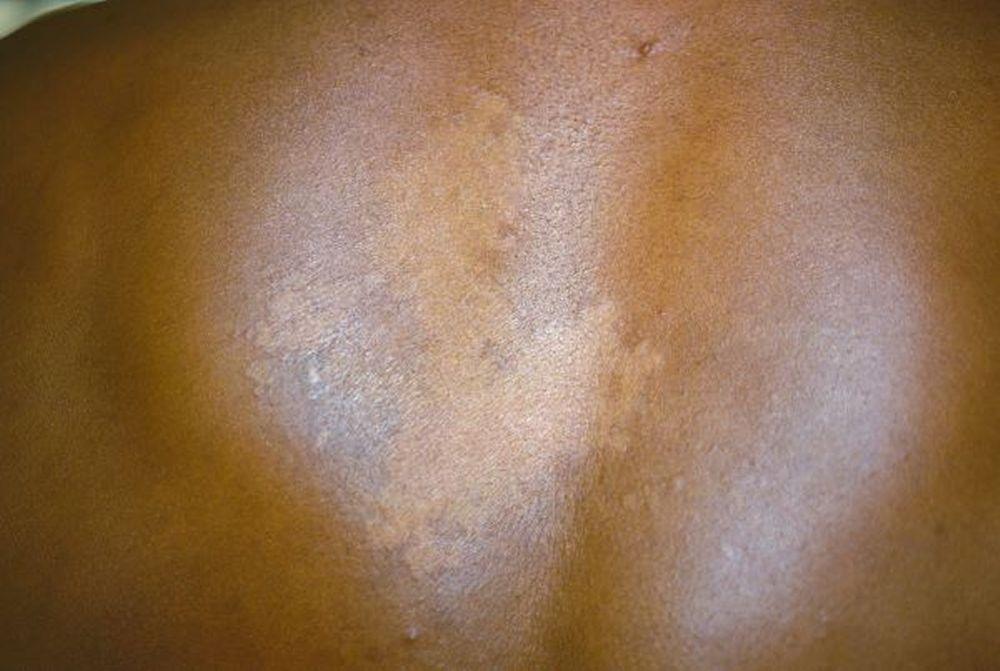 Tinea Versicolor With Hypopigmented Patches on the Back