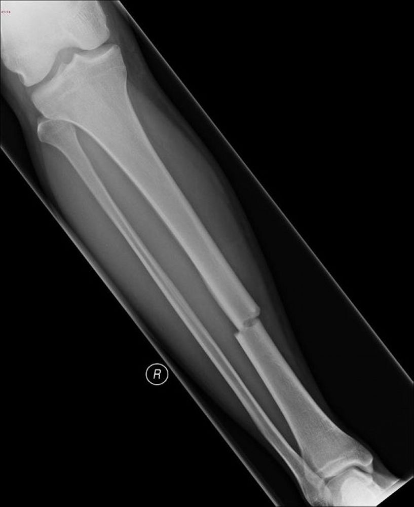 LOQTEQ Femur Distal Periprotesica | PDF | Parafuso, image size:817x1000