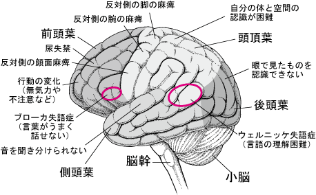 失語 - 09. 脳、脊髄、末梢神経の病気 - MSDマニュアル家庭版