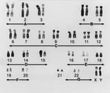 Chromosome abnormalities