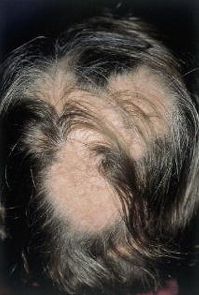 Alopecia Areata - Skin Disorders - MSD Manual Consumer Version