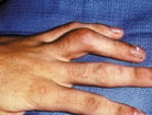 Rheumatoid Arthritis (RA)