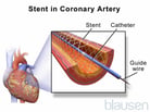 Overview of Coronary Artery Disease (CAD)